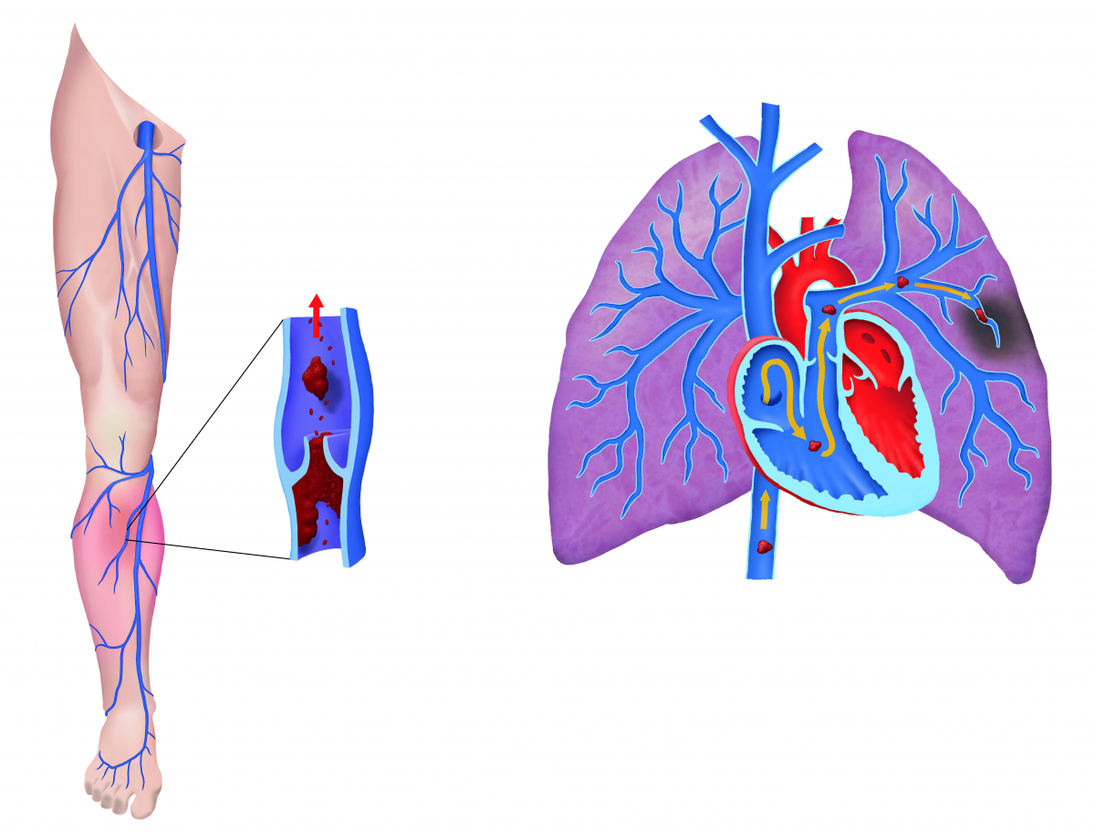 Longembolie - Heelkunde tielt