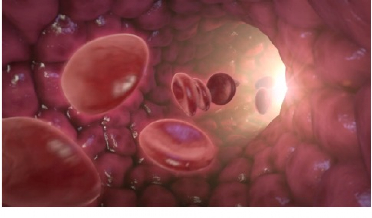 Veneuze trombose - Heelkunde tielt