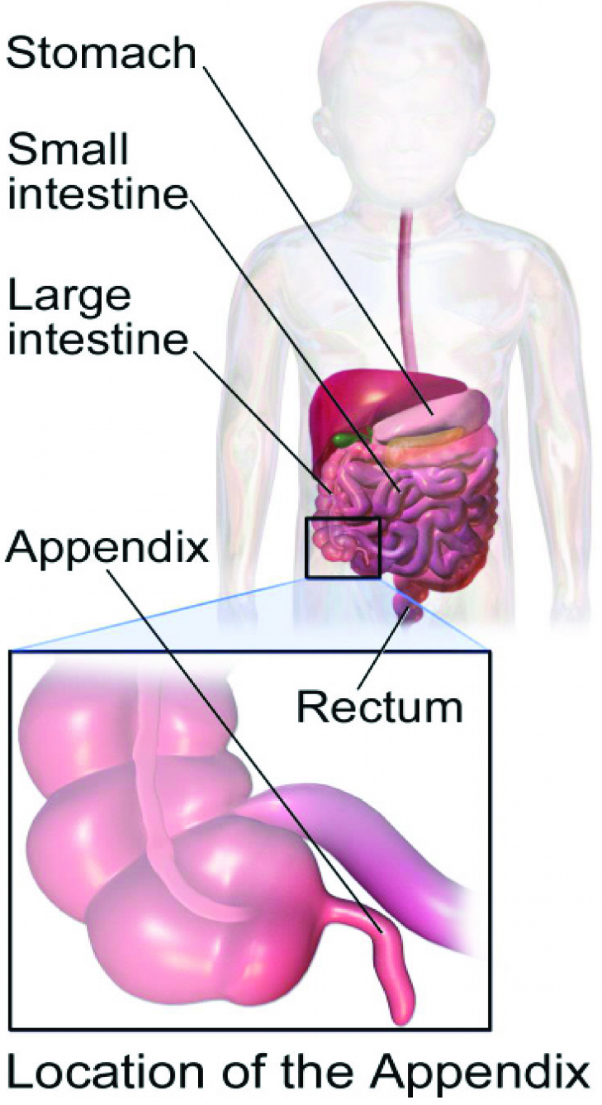 Appendicitis of blindedarmontsteking - Heelkunde tielt