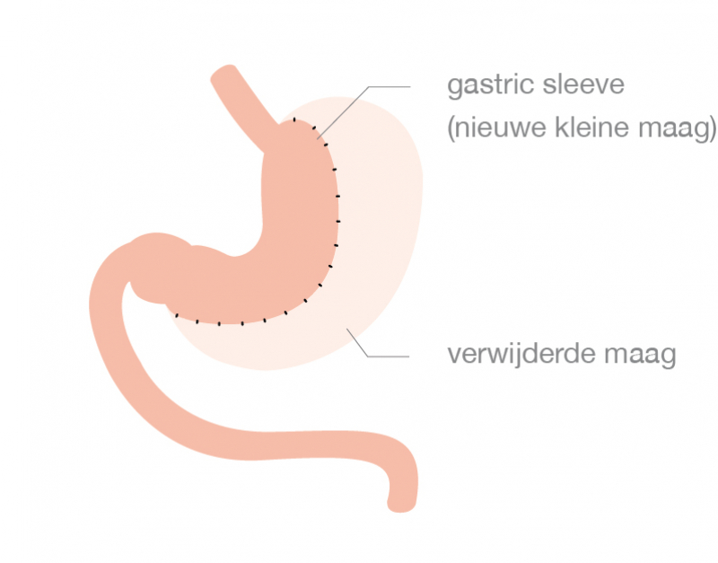Sleeve gastrectomie Heelkunde tielt
