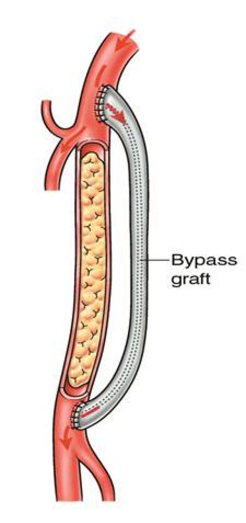 Voorbeeld van een bypass