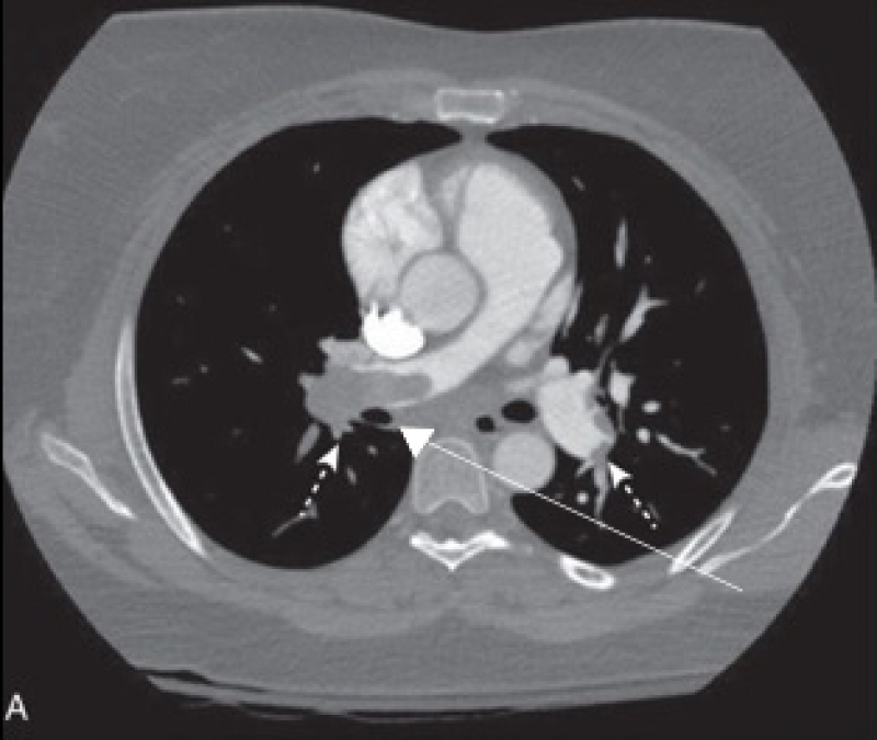 Figuur: beeld van CT-scan met longembool.