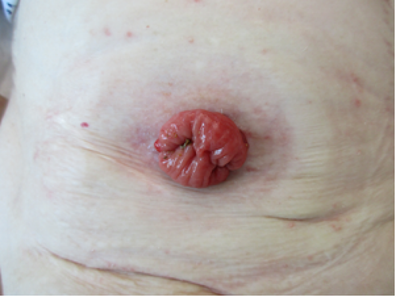 Stoma voorbeeld