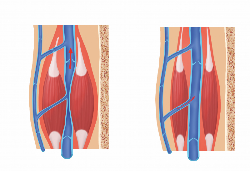 De bloedcirculatie na spataderbehandeling Heelkunde tielt De bloedcirculatie na spataderbehandeling Heelkunde tielt