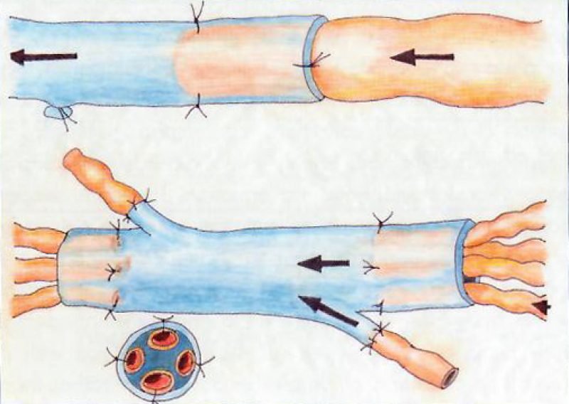 Schematische weergave van een microchirurgische lymfo veneuze anastomose (LVA)
