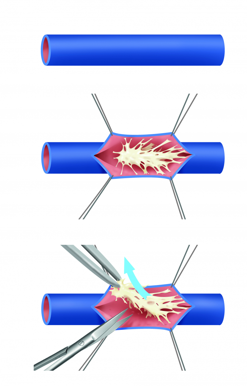 Figuur: Endophlebectomie of het heelkundig verwijderen van trabeculaties in de ader.