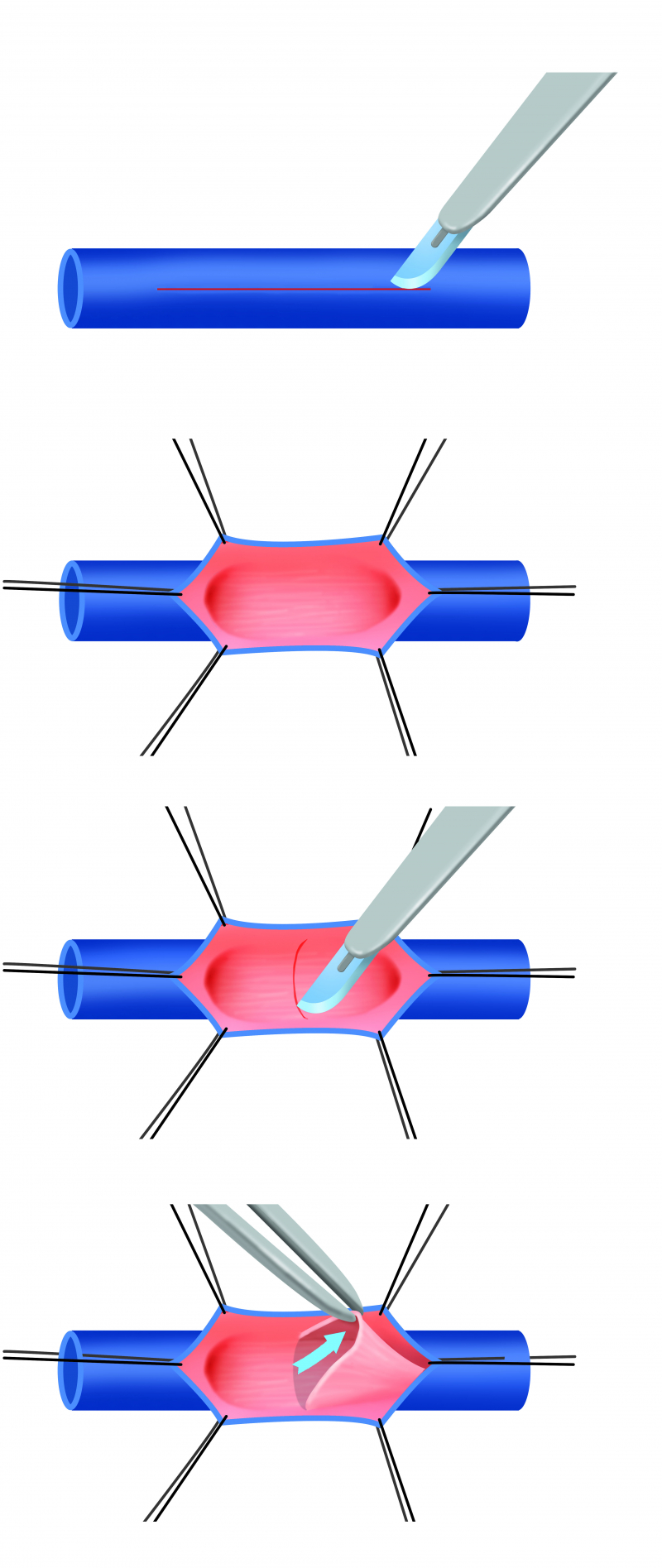 Figuur: schematische voorstelling van een het vormen van en nieuwe klep, een noeovalve.