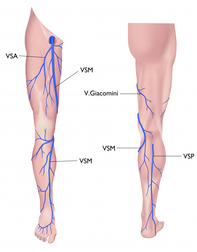 Anatomie van het oppervlakig veneus systeem. VSM: Vena Safena Magna | VSP: Vena Safena Parva | VSA: Vena Safena Accessoria anterior | Vena van Giacomini